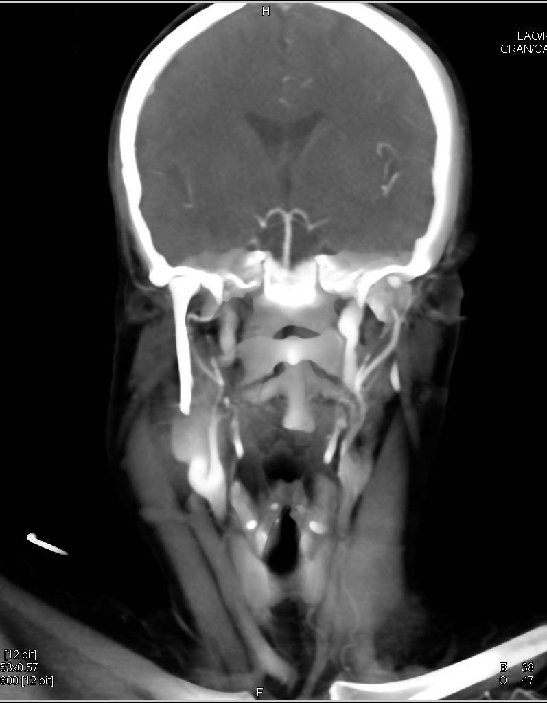 Carotid Artery Aneurysm in a Patient with Vascular Ehlers-Danlos Syndrome - CTisus CT Scan