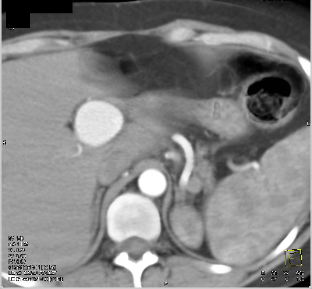 Hepatic Artery Aneurysm in a Patient with Ehlers-Danlos Vascular Syndrome - CTisus CT Scan