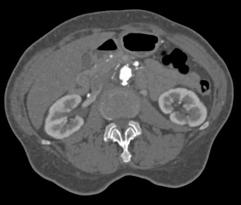 Right Common Iliac Disease with Fem-Fem Bypass - CTisus CT Scan