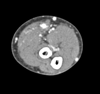 Arteriovenous (AV) Shunt in Dialysis Patient - CTisus CT Scan