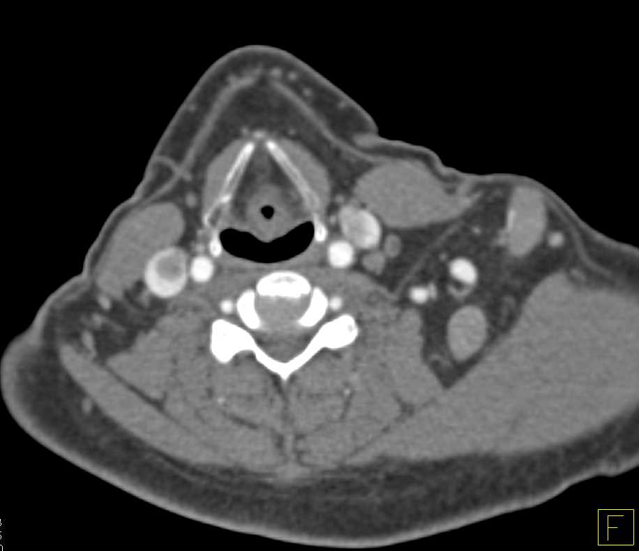 Clot in Jugular Veins and Large Left Supraclavicular Collaterals - CTisus CT Scan