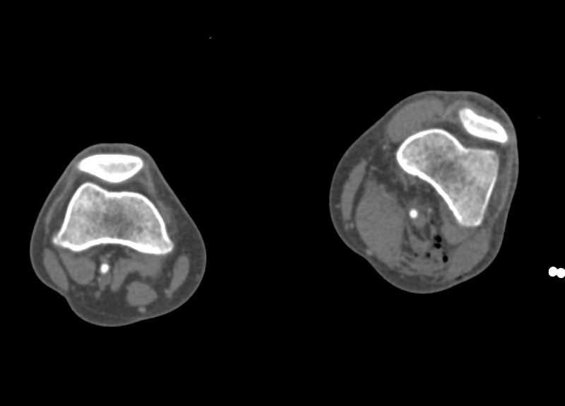 GSW in Popliteal Fossa but Vessels are Normal - CTisus CT Scan