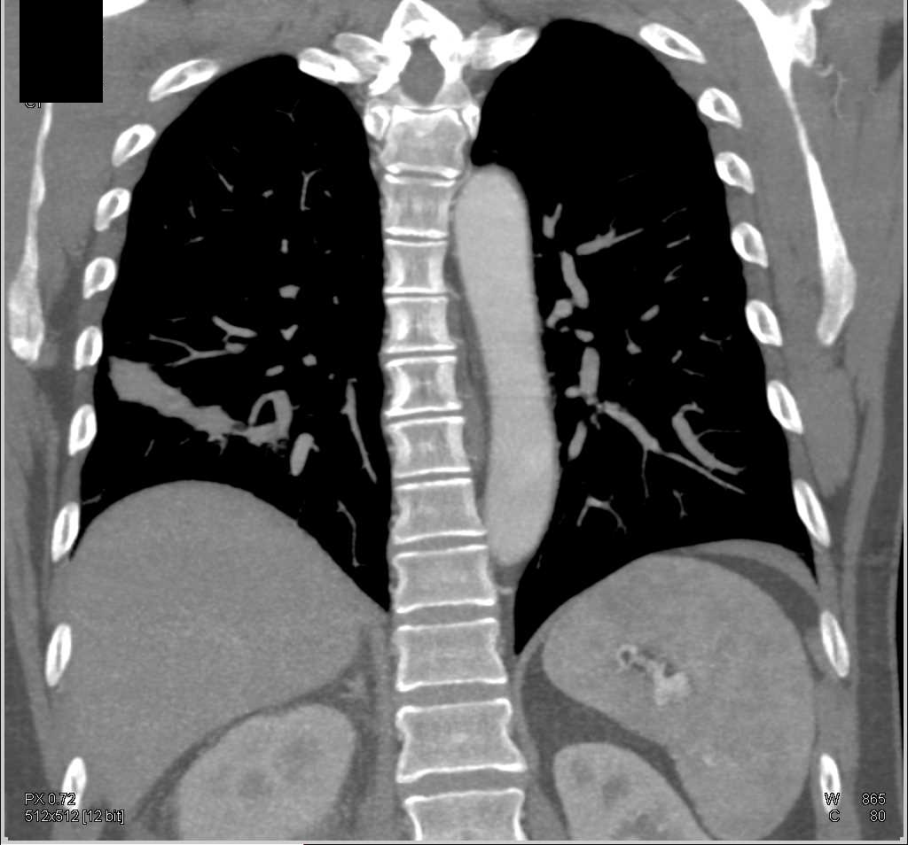 Ehlers-Danlos Syndrome with Bleeding Right Renal Artery Aneurysm and Hepatic Artery Aneurysm - CTisus CT Scan