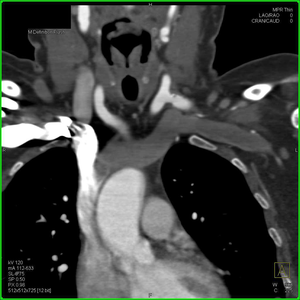Bypass Graft from Left Carotid to Left Subclavian Artery - CTisus CT Scan