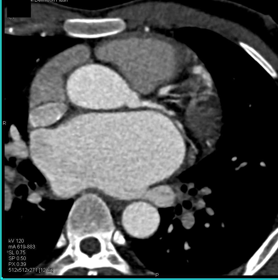 Post Repair of Coarctation of the Aorta - CTisus CT Scan