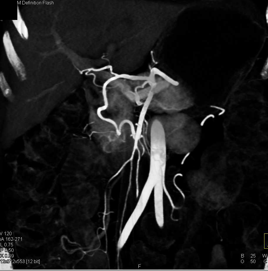 Sagittal View Shows Narrowed Celiac Artery with Median Arcuate Ligament Syndrome - CTisus CT Scan