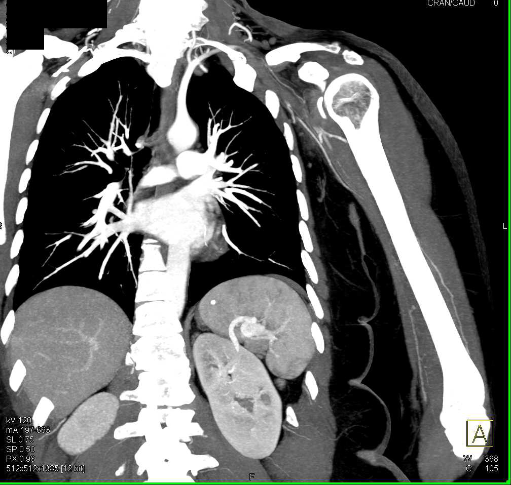 Left Subclavian Artery Occlusion with Soft Tissue Mass - CTisus CT Scan