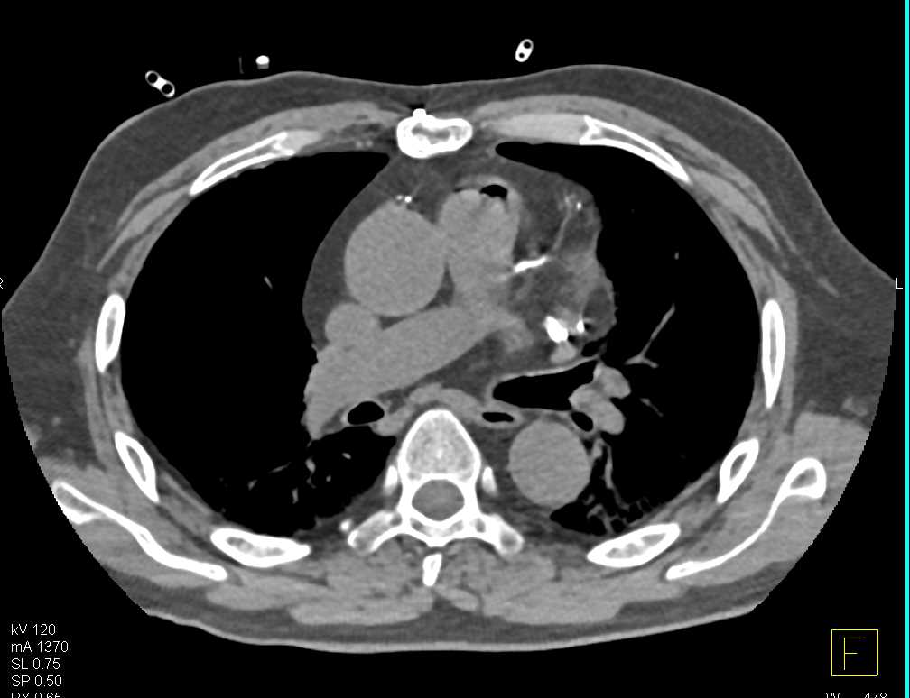 Leaking Abdominal Aortic Aneurysm - CTisus CT Scan