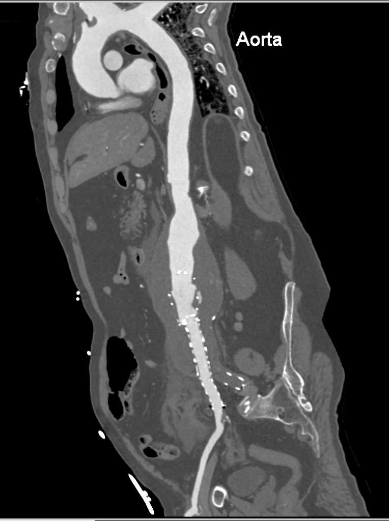 Leaking Abdominal Aortic Aneurysm - CTisus CT Scan