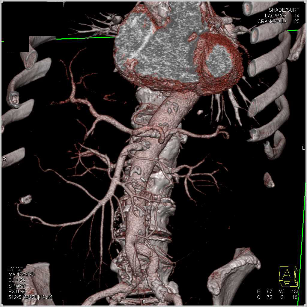 Atherosclerotic Disease in the Aorta - CTisus CT Scan