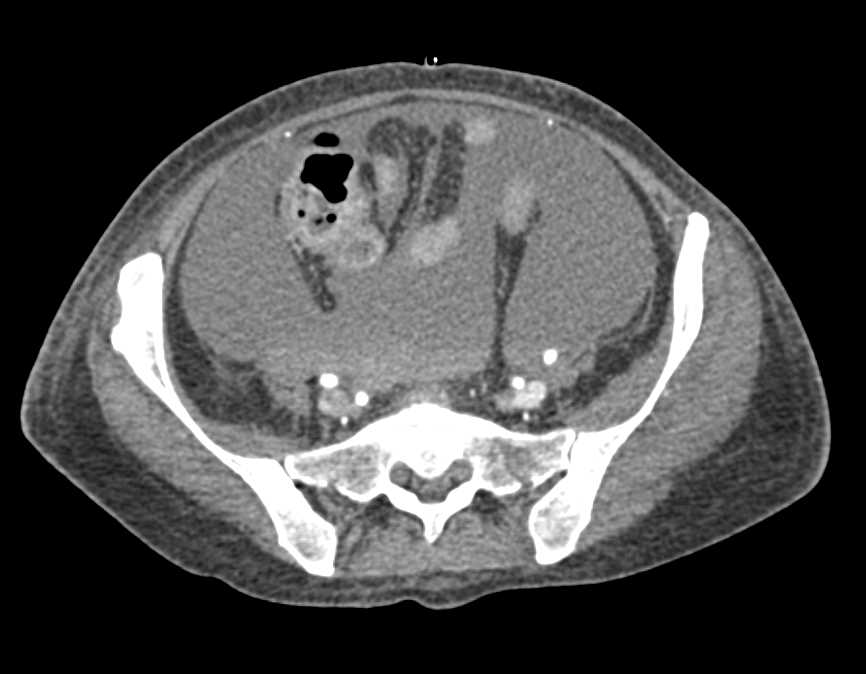 Arteriovenous (AV) Fistulae with Active Bleed in the Pelvis - CTisus CT Scan