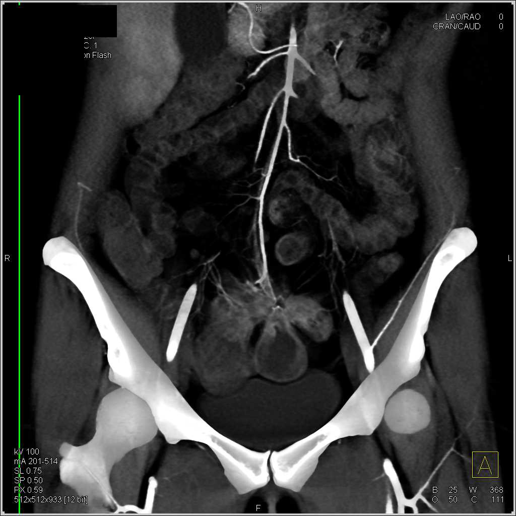 Vasculitis with Superior Mesenteric Artery (SMA) Involvement and Colitis - CTisus CT Scan