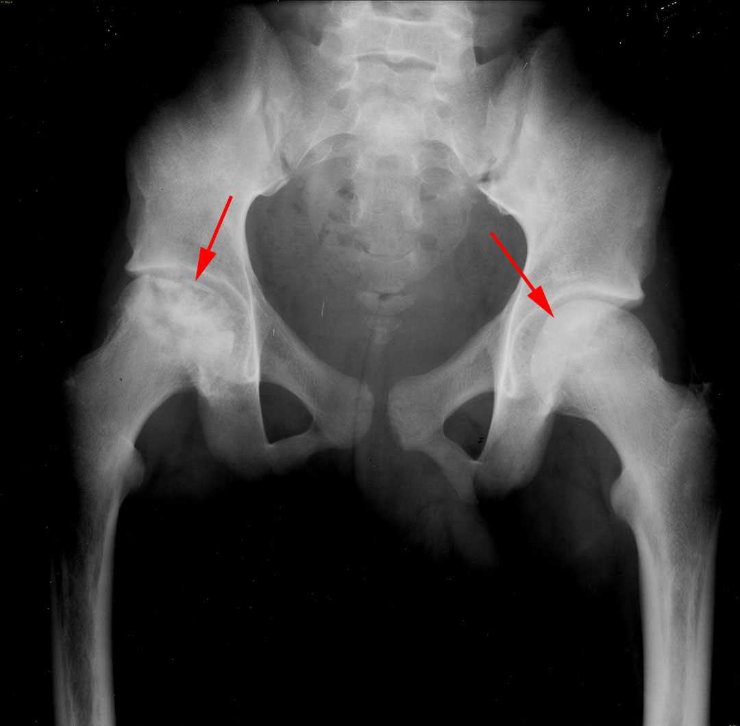 Avascular necrosis of the femoral heads - X Rays Case Studies - CTisus