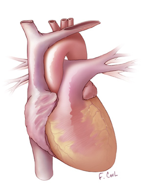 64 MDCT Heart