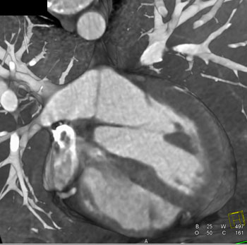 cardiac 64 mdct