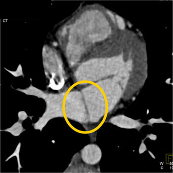 cardiac 64 mdct