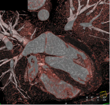 cardiac 64 mdct