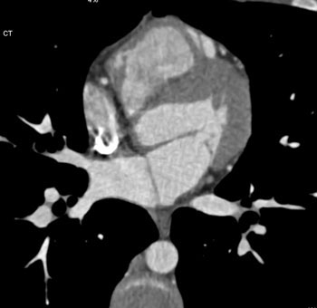 cardiac 64 mdct