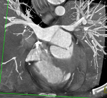 cardiac 64 mdct