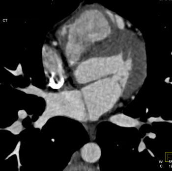 cardiac 64 mdct