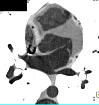 cardiac 64 mdct