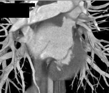 cardiac 64 mdct