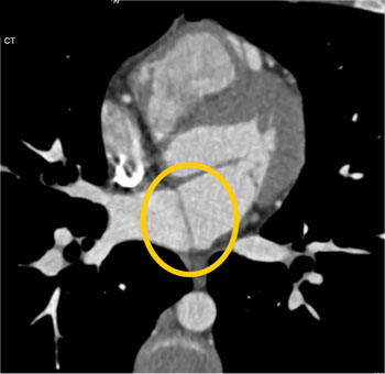 cardiac 64 mdct