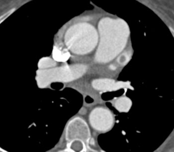 cardiac 64 mdct