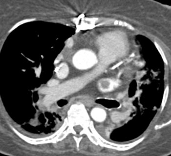 cardiac 64 mdct