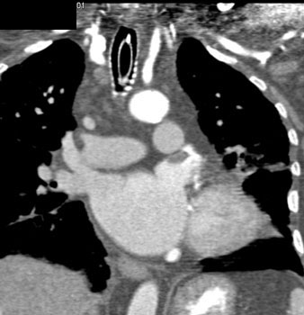 cardiac 64 mdct