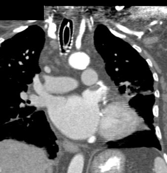 cardiac 64 mdct