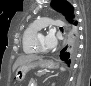 cardiac 64 mdct