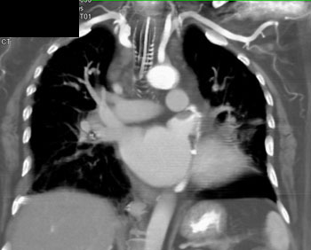 cardiac 64 mdct