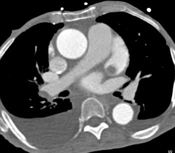 cardiac 64 mdct