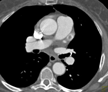 cardiac 64 mdct