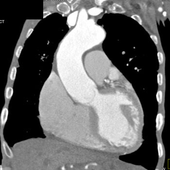 cardiac 64 mdct