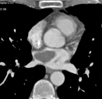 cardiac 64 mdct