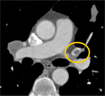 cardiac 64 mdct