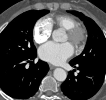 cardiac 64 mdct