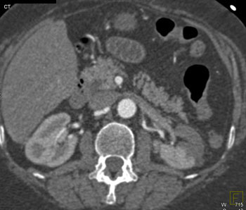 cardiac 64 mdct