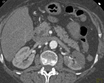 cardiac 64 mdct