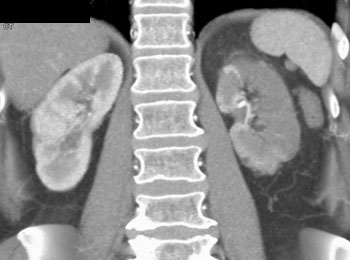 cardiac 64 mdct