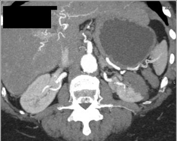 cardiac 64 mdct