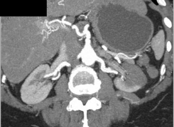 cardiac 64 mdct