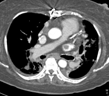 cardiac 64 mdct