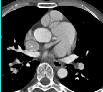 cardiac 64 mdct