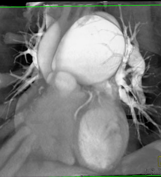 cardiac 64 mdct