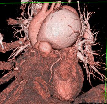 cardiac 64 mdct