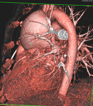 cardiac 64 mdct