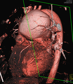 cardiac 64 mdct